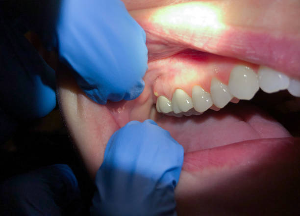 Best Emergency Cosmetic Dentistry (e.g., broken veneers) in Merryville, LA